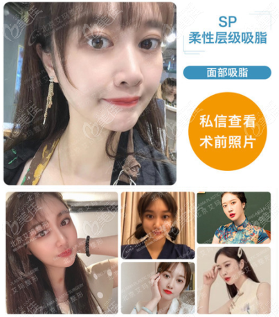 北京韦元强的sp柔性层级面部吸脂不错,不但脸小了而且