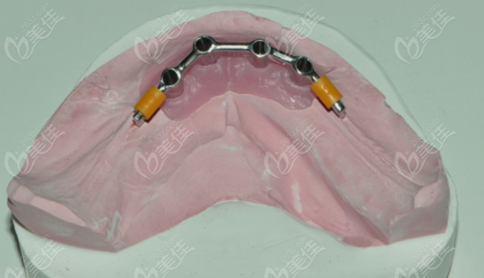 以下是口腔种植牙马龙桥的视频图解哦~ 口腔种植牙马龙桥图解(以是