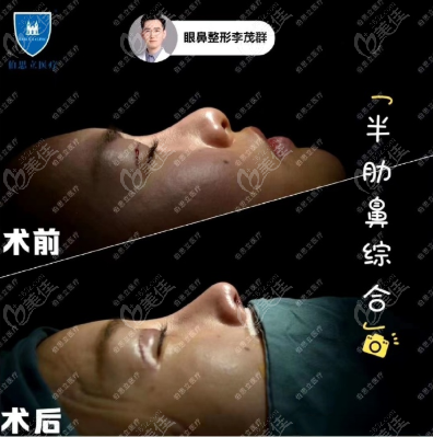 重庆百达丽李医生不只做双眼皮效果好鼻子做的也蛮出色