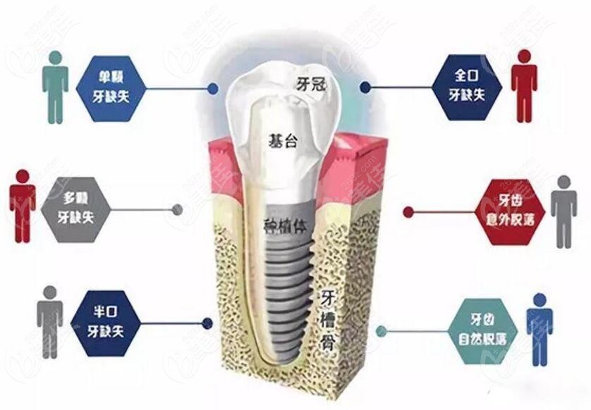 在国内一二线城市法国安卓健种植体价格在13800元起,但是做过种植牙的