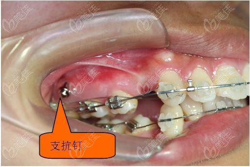 注意啦正畸支抗钉的植入位置不是固定滴颧牙槽嵴部位要注意这些
