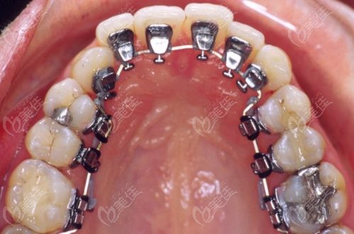 牙齿畸形的症状有很多,医生会根据牙齿的情况推荐适合的牙齿矫治方式