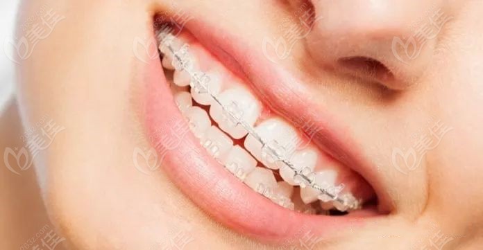 新乡口腔医院矫正牙齿多少钱隐形牙套和舌侧矫正器的价格都要