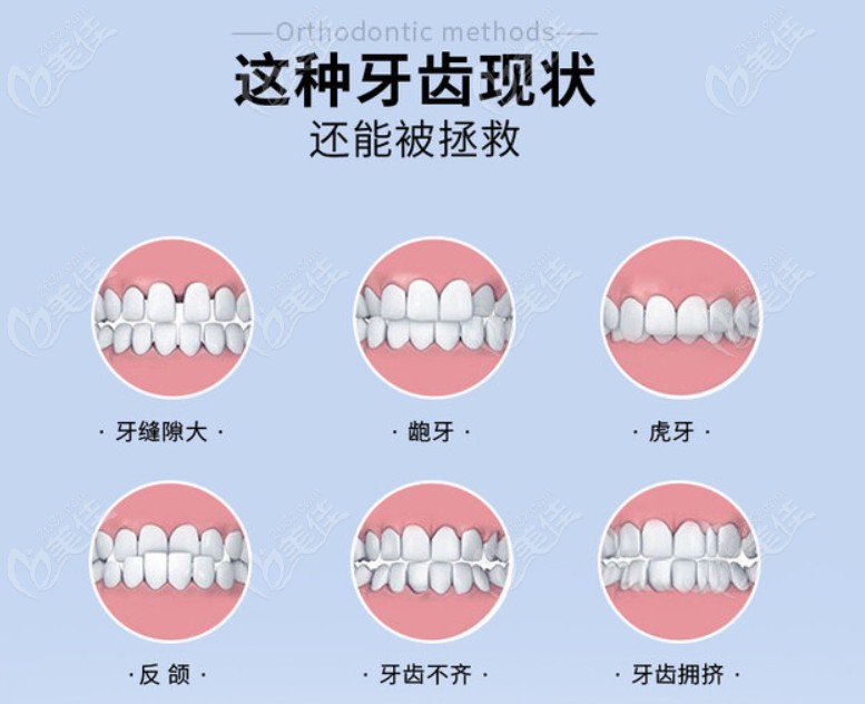 需要做正畸的牙齿情况分类▼