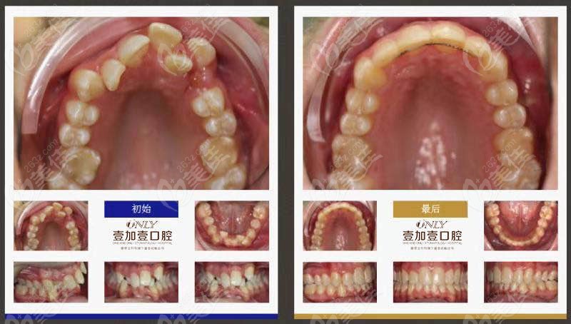 张莹医生做牙齿排列不齐的矫正牙齿拥挤矫正之后恢复正常小编的分享到