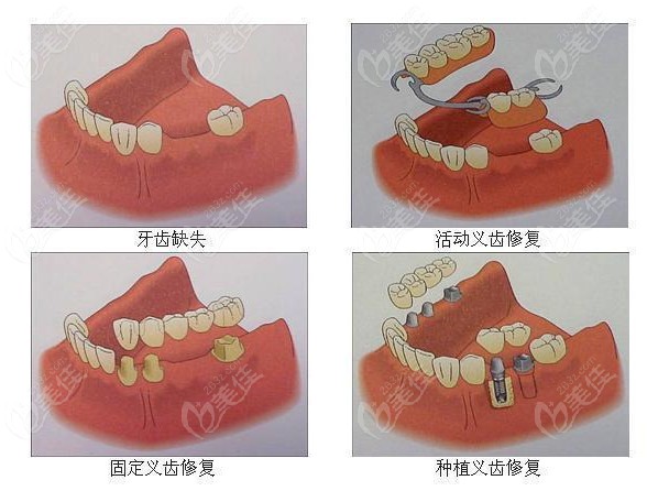 牙齿缺失的各种修复方式