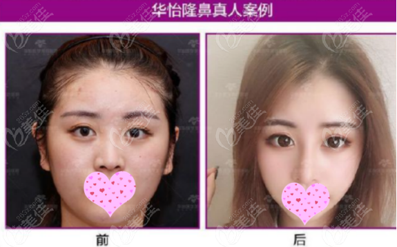 烟台哪家整形医院好一些呢,这份排行榜中介绍的都是技术好的