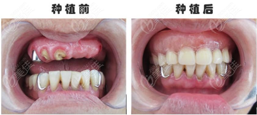 南阳植得口腔种植牙多少钱一颗答案就在这份价格表里