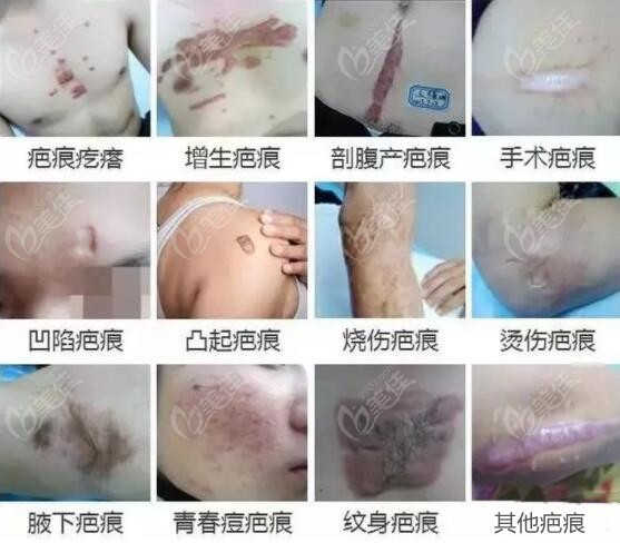 要把疤痕修复好一般要花多少钱疤痕修复手术费用是这么算的
