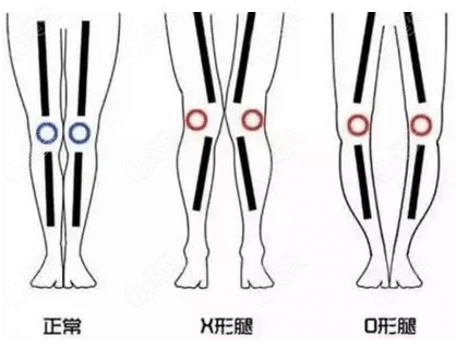 北京禾美嘉做x/o型腿矫正挺好的,从芭蕾纤腿平行术优势可以看出