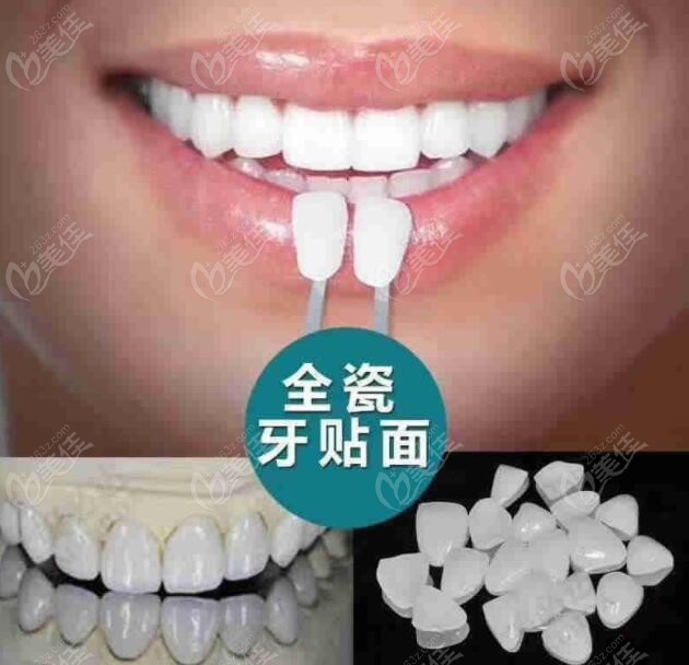 深圳南山区美奥口腔做超薄全瓷贴面美牙的价格公示啦你们觉得贵吗