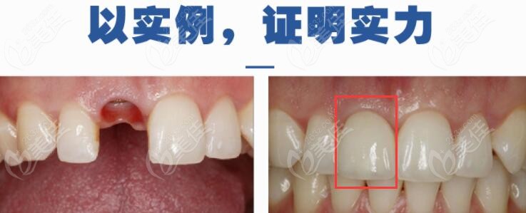 听说北京钛植口腔专做种植牙那林磊医生的即刻种植技术怎么样呢
