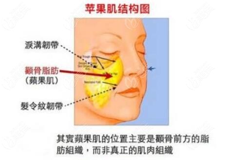 沈阳杏林朱石江解答:颧骨过高,做颧骨颧弓内推手术会影响苹果肌吗?