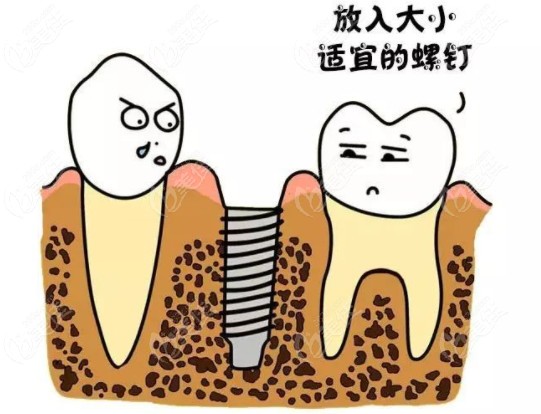 昆明美奥口腔种植牙齿多少钱一颗半全口韩系的那种