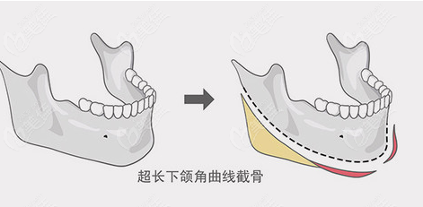 上海下颌角手术哪家医院做的好呢汇总排名前五都是口碑好的实力派医院