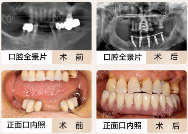 牙的即刻微创种植,骨量不足的植骨种植,all-on-4,all-on-6全口/半口
