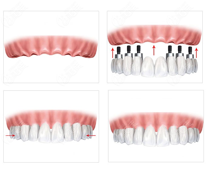 半口全固定种植牙是比较好的一种牙齿缺失修复方法,牙齿的咀嚼力比较