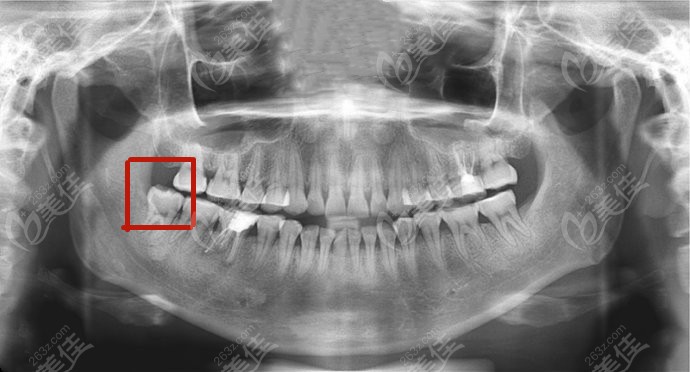 上颌阻生智齿(牙齿不能完全长出来,拔除时需要切开牙组织表面的黏膜)