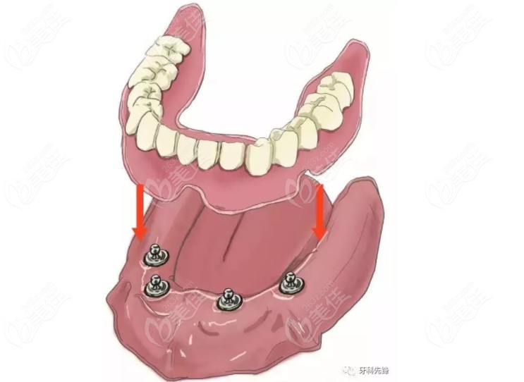 固定种植牙就是用2颗或者4颗植体来修复半口牙,植体和牙冠需要靠球帽