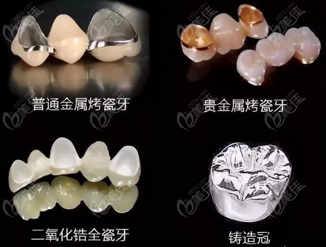 峰煜口腔的牙冠分类