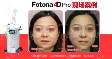 fotona 4d pro真人体验术前术后对比照