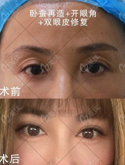 不同之处,北京丽星翼美魏志香院长做内眼角修复,眼袋修复手术也很擅长