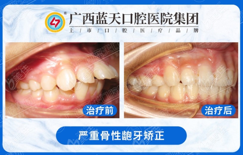 下面这位是骨性龅牙的顾客,矫正后的对比图,效果是不是也很不错,整个