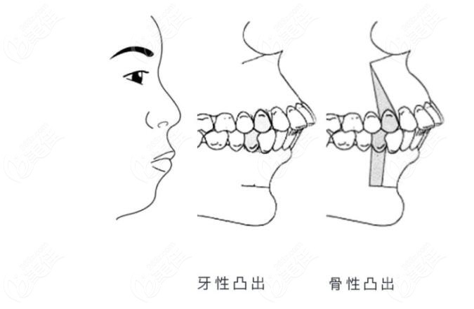 正颌手术和正畸的区别是什么例如骨性牙突是靠手术还是矫正改善