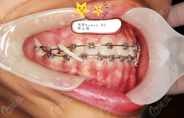听牙医说美国戴蒙damonq2金属自锁托槽矫正器可以减少拔牙的几率哦