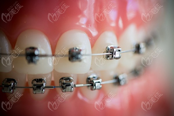 听牙医说:美国戴蒙damonq2金属自锁托槽矫正器可以减少拔牙的几率哦