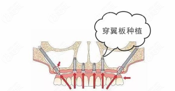 穿翼种植牙示意图