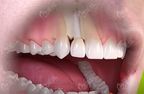 宁波牙博士口腔医院的种植牙技术怎么样呀家里老人想来种植全口假牙