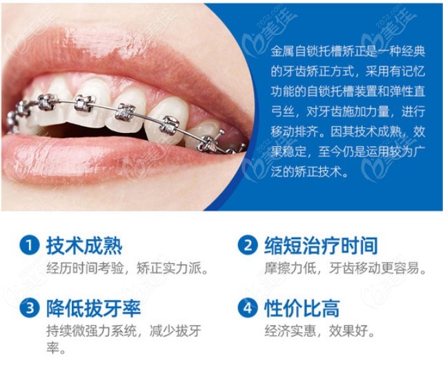 暑期在上海戴金属自锁牙套矫正牙齿大概多少钱?美奥口腔只要8888元起
