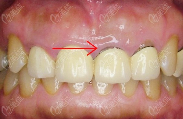 劣质烤瓷冠导致牙龈黑线