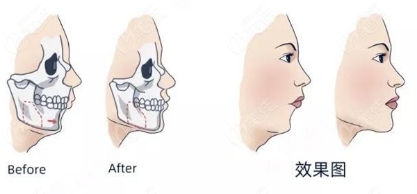 武汉做正颌正畸手术比较好的医院及正颌手术费用大盘点