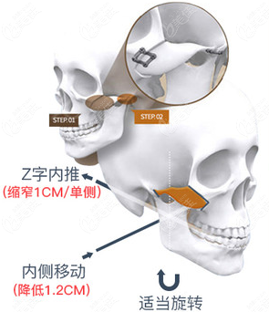 在杭州做颧骨内推到底哪家医院好啊?为啥说时光整形做