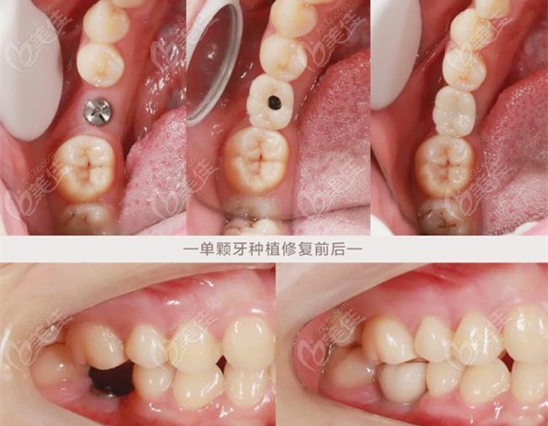单颗种植牙修复前后的效果图