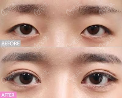 新疆整形医院眼综合手术效果图对比