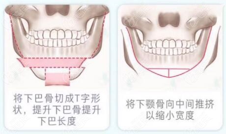 为什么下巴t型截骨手术不建议做来看沈阳杏林朱石江的介绍