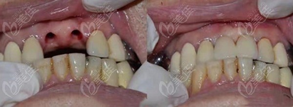 附上几例米兰口腔种植牙院长贾楠做的种植牙实例吧,方便参考 看完