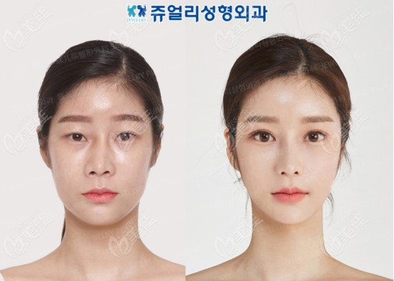 韩国面部整形哪家医院好呢珠儿丽凭眼鼻综合全脸脂肪填充效果图入围
