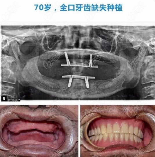 下面是一位70岁老人全口牙齿缺失,聂医生选用数字化即刻种植技术,仅