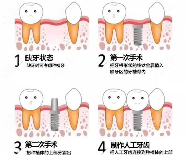 传统种植牙的过程图