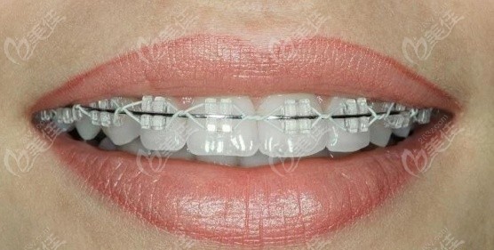 哪种牙齿矫正器效果比较好在整牙前想知道各种矫治器的种类和价格