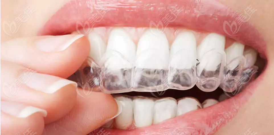 哪种牙齿矫正器效果比较好在整牙前想知道各种矫治器的种类和价格