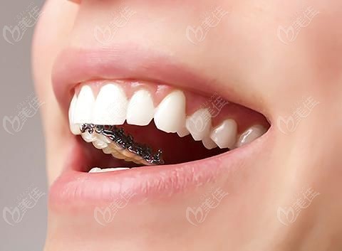 舌侧金属隐形矫正牙套—牙齿矫正器中的"黑马"