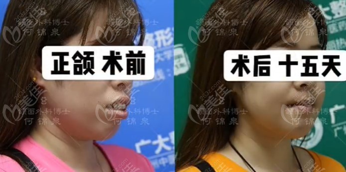 骨性凸嘴做正颌手术费用是多少上海和广州正颌手术价格差别有点大