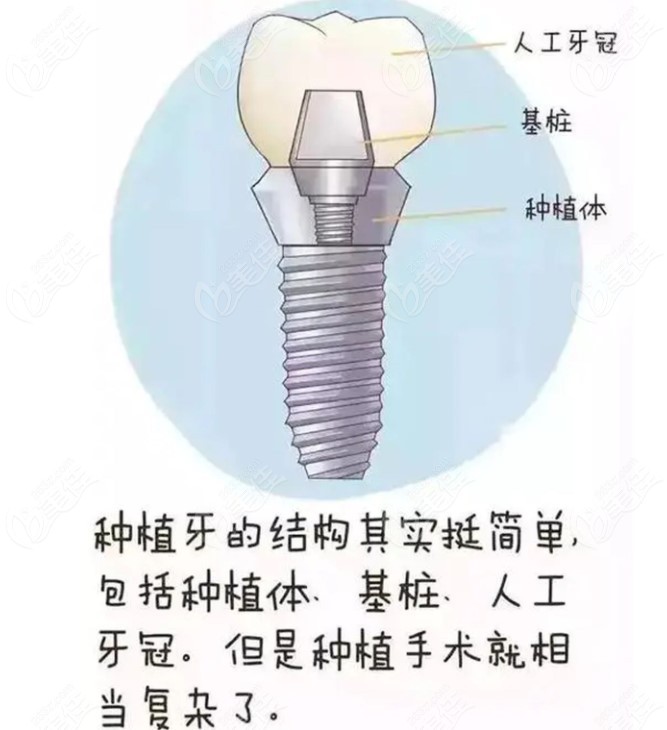 一颗种植牙2980元能靠谱吗3980元一颗的质量会不会更好点