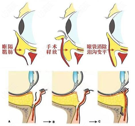 大连爱德丽格医疗美容做内路眶隔释放祛眼袋效果怎么样费用要多少钱