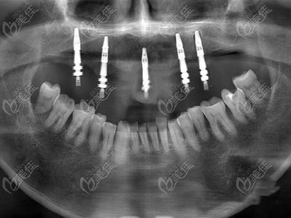40岁上半口种植5颗牙恢复半口效果图赏析费用也不贵